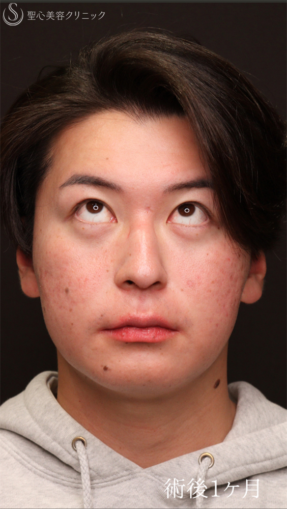 【20代男性・クマ施術で疲れみえを改善】裏ハムラ法（1ヶ月後） After 