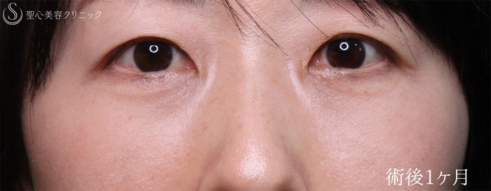 【40代女性・クマ治療で疲れみえをスッキリ改善】裏ハムラ法（直後～1ヶ月後） After 
