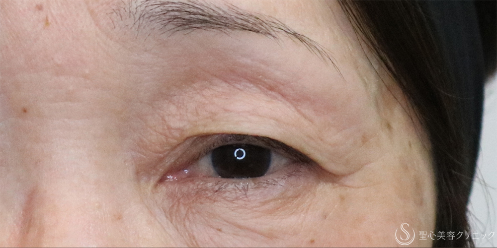 【60代女性・目の開きを改善】眼瞼下垂（切開法）＋眉下切開術（3ヶ月後） Before 名古屋+二重　埋没法　眼瞼下垂　まぶたたるみ　眉下切開