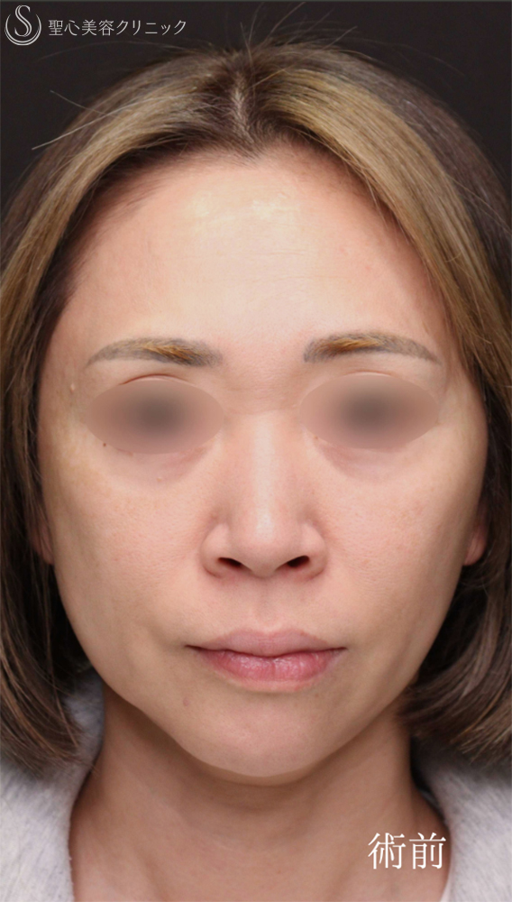 【40代女性・お鼻のアンチエイジング】小鼻縮小＋鼻孔縁下降術（1ヶ月後） Before 