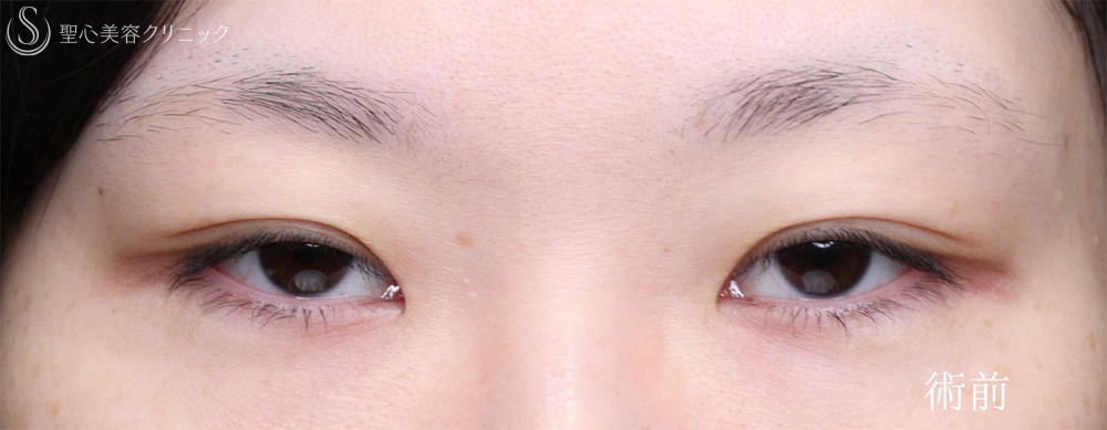【30代女性・目力を改善】眼瞼下垂手術＋目頭切開（4ヶ月後） Before 