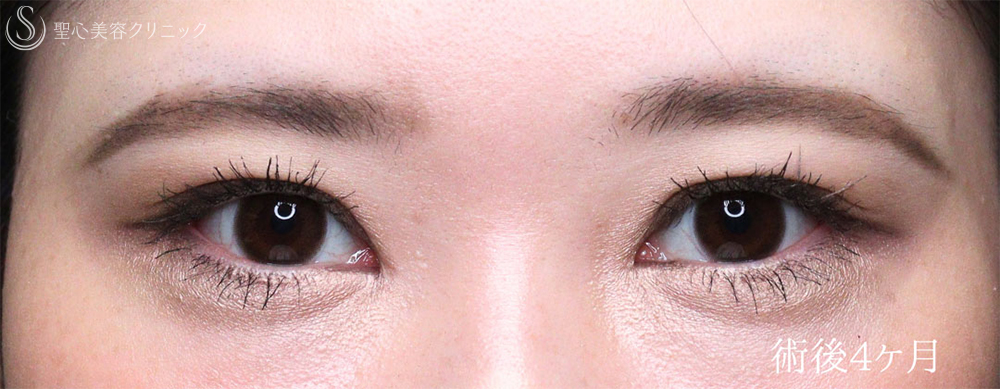 【30代女性・目力を改善】眼瞼下垂手術＋目頭切開（4ヶ月後） After 