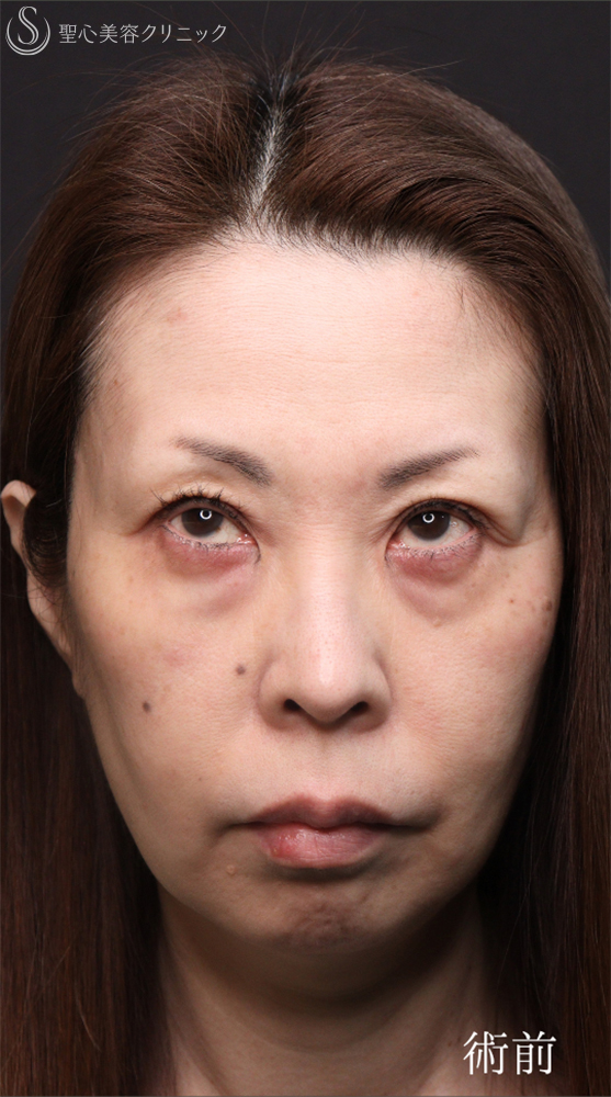 【50代女性・クマ治療で劇的な若返り】ハムラ法＋ミッドチークリフト（直後～1ヶ月後） Before 