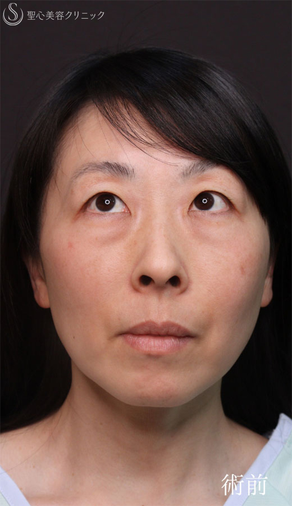 【40代女性・クマ治療で疲れみえをスッキリ改善】裏ハムラ法（直後～1ヶ月後） Before 