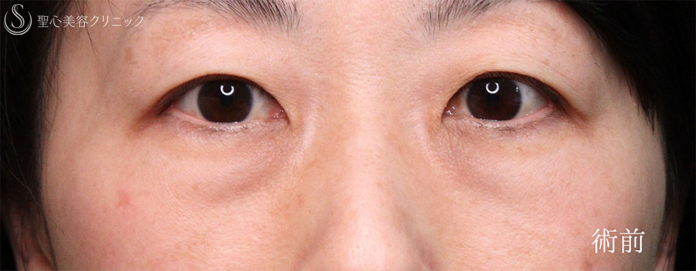 【40代女性・クマ治療で疲れみえをスッキリ改善】裏ハムラ法（直後～1ヶ月後） Before 