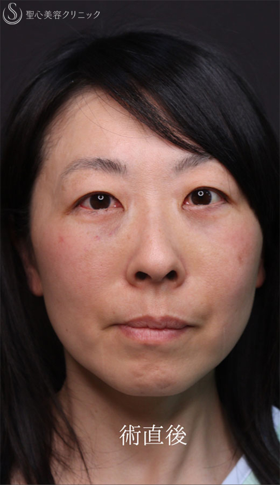 【40代女性・クマ治療で疲れみえをスッキリ改善】裏ハムラ法（直後～1ヶ月後） After 