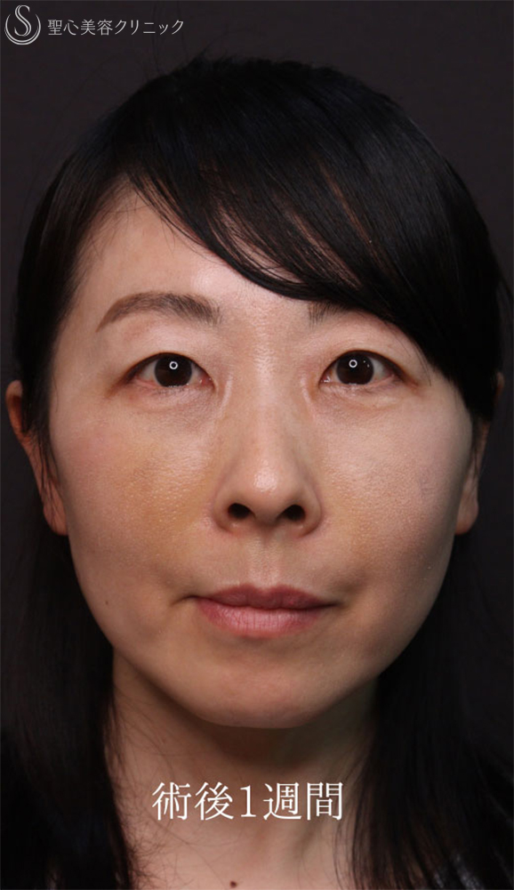 【40代女性・クマ治療で疲れみえをスッキリ改善】裏ハムラ法（直後～1ヶ月後） After 