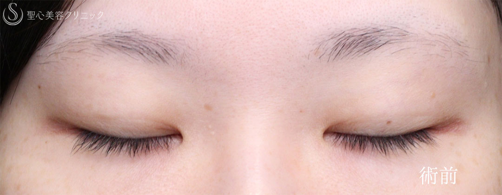 【30代女性・目力を改善】眼瞼下垂手術＋目頭切開（4ヶ月後） Before 