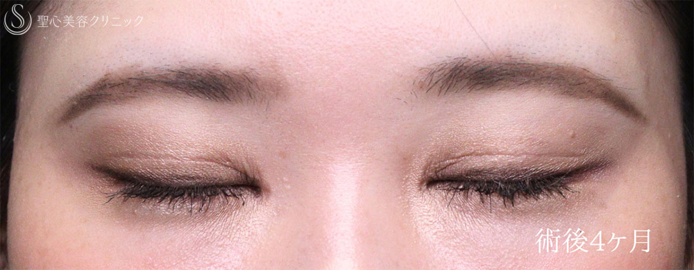 【30代女性・目力を改善】眼瞼下垂手術＋目頭切開（4ヶ月後） After 