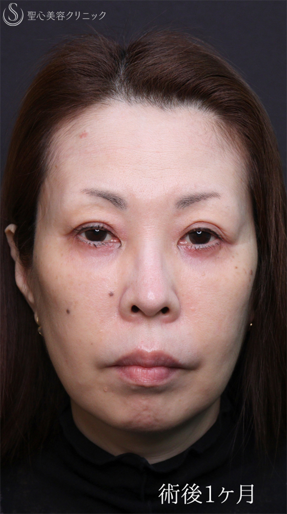 【50代女性・クマ治療で劇的な若返り】ハムラ法＋ミッドチークリフト（直後～1ヶ月後） After 