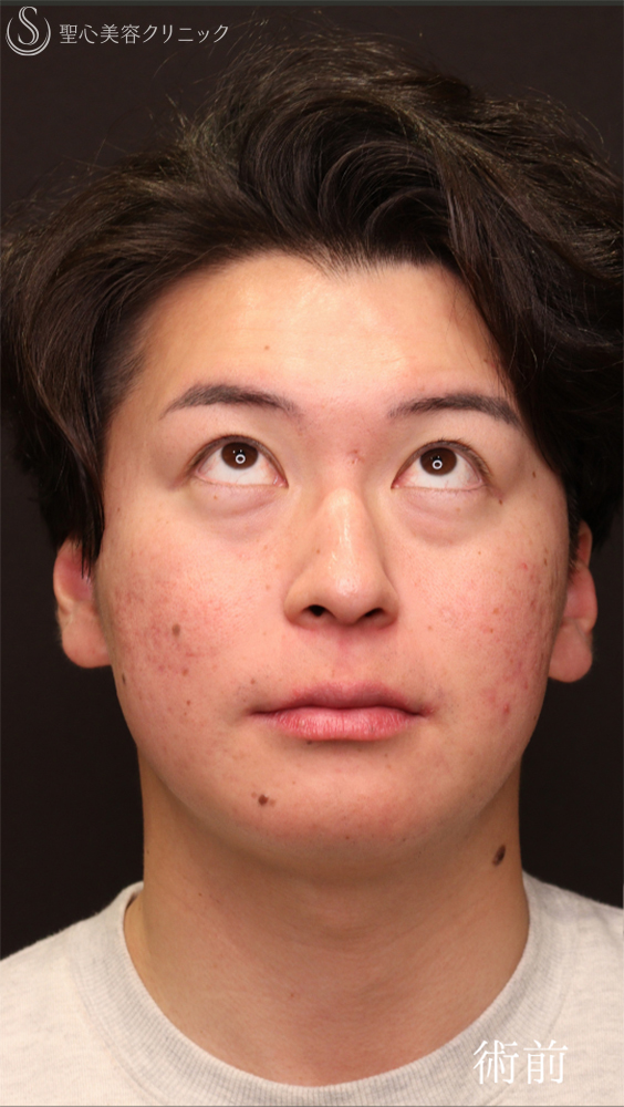 【20代男性・クマ施術で疲れみえを改善】裏ハムラ法（1ヶ月後） Before 