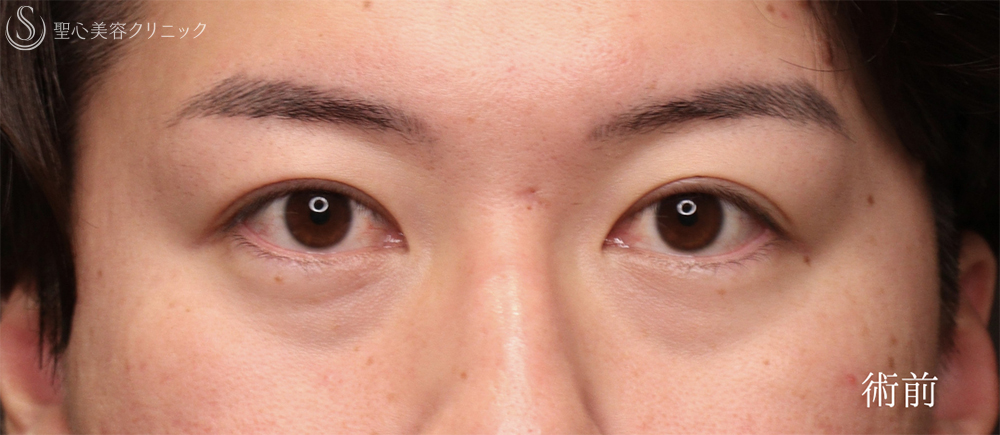 【20代男性・クマ施術で疲れみえを改善】裏ハムラ法（1ヶ月後） Before 