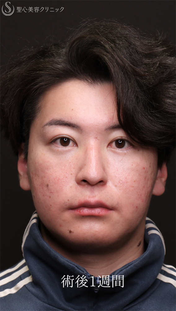 【20代男性・クマ施術で疲れみえを改善】裏ハムラ法（1ヶ月後） After 