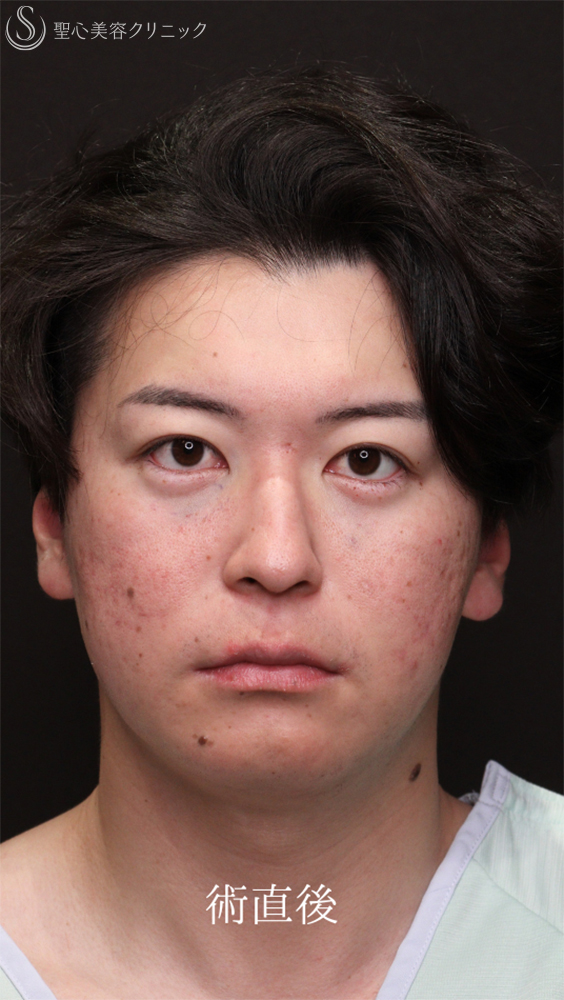 【20代男性・クマ施術で疲れみえを改善】裏ハムラ法（1ヶ月後） After 