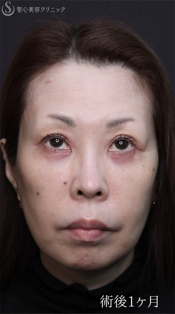 【50代女性・クマ治療で劇的な若返り】ハムラ法＋ミッドチークリフト（直後～1ヶ月後） After 