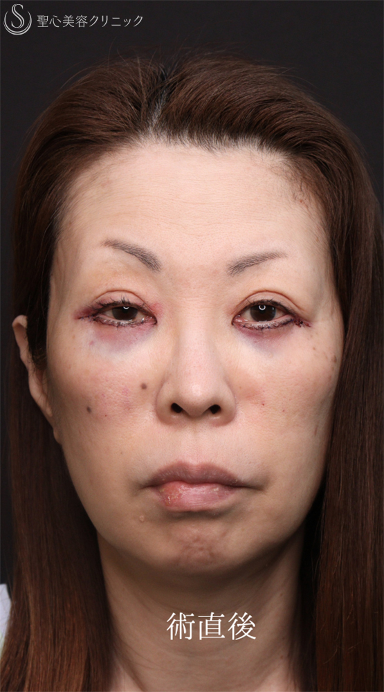 【50代女性・クマ治療で劇的な若返り】ハムラ法＋ミッドチークリフト（直後～1ヶ月後） After 