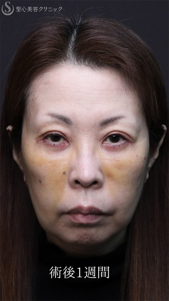 【50代女性・クマ治療で劇的な若返り】ハムラ法＋ミッドチークリフト（直後～1ヶ月後） After 