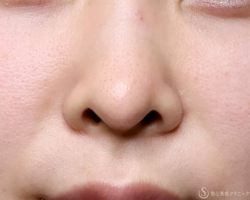 【30代女性・鼻の穴が見えるのが気になる】鼻孔縁下降術（1週間後） Before 