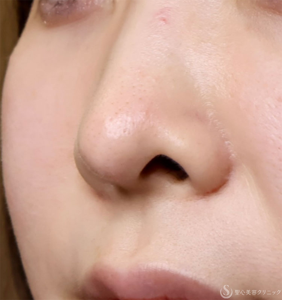 【30代女性・鼻の穴が見えるのが気になる】鼻孔縁下降術（1週間後） Before 