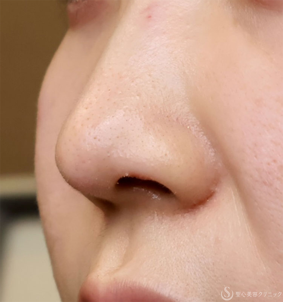 【30代女性・鼻の穴が見えるのが気になる】鼻孔縁下降術（1週間後） After 
