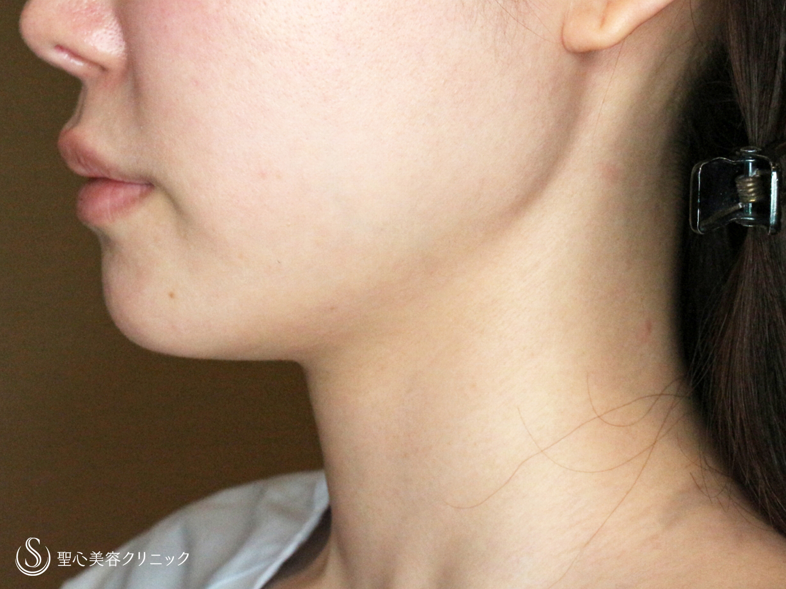 【30代女性・美しいフェイスラインで小顔に】脂肪吸引注射「あご下」（直後〜2ヶ月後） Before 