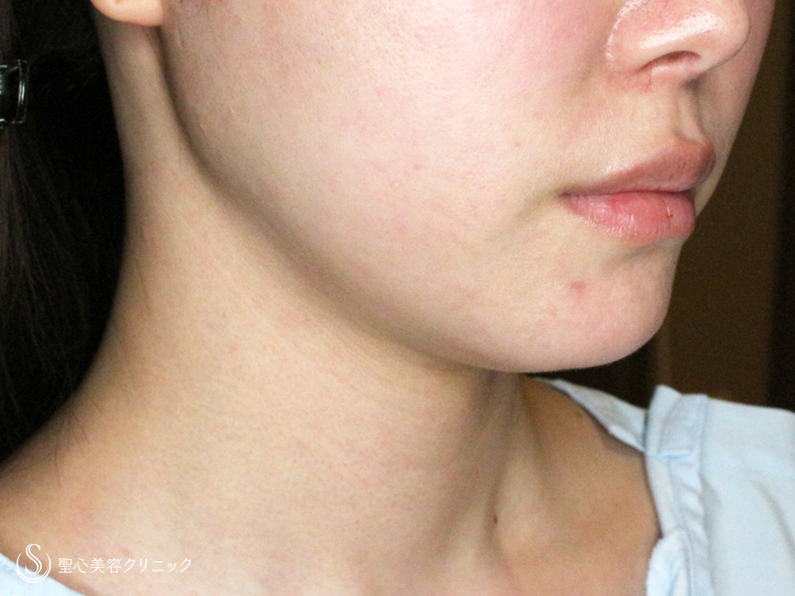 【30代女性・美しいフェイスラインで小顔に】脂肪吸引注射「あご下」（直後〜2ヶ月後） Before 
