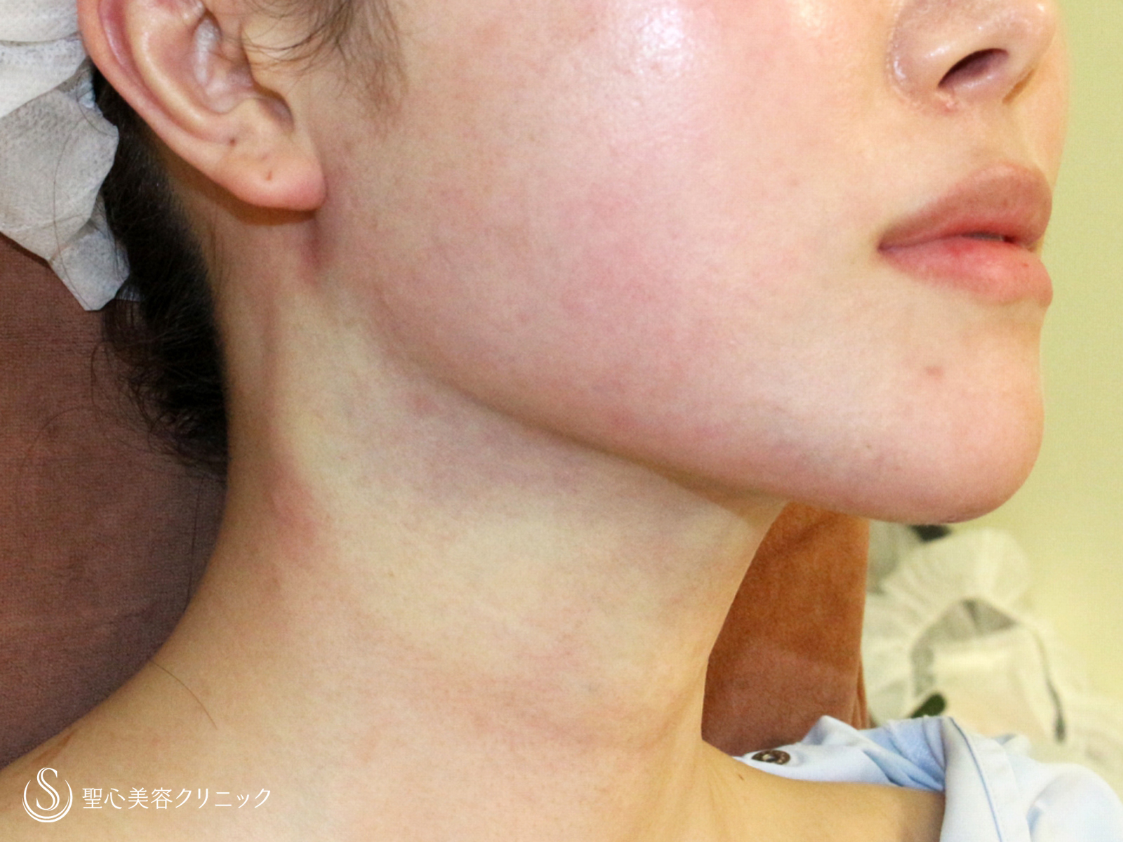 【30代女性・美しいフェイスラインで小顔に】脂肪吸引注射「あご下」（直後〜2ヶ月後） Before 