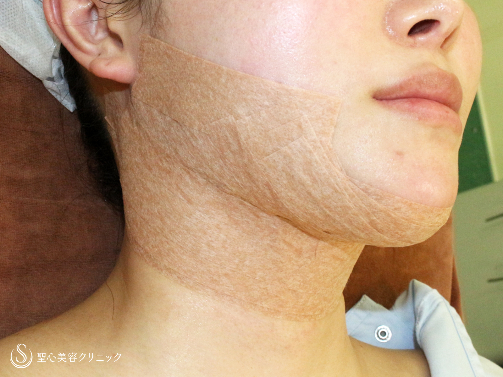 【30代女性・美しいフェイスラインで小顔に】脂肪吸引注射「あご下」（直後〜2ヶ月後） After 