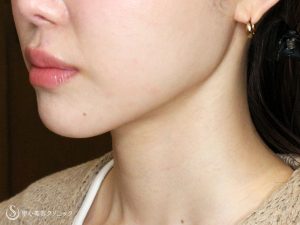 エラ張りの悩みを解決！専門家が教える原因と効果的な方法【エラ張り