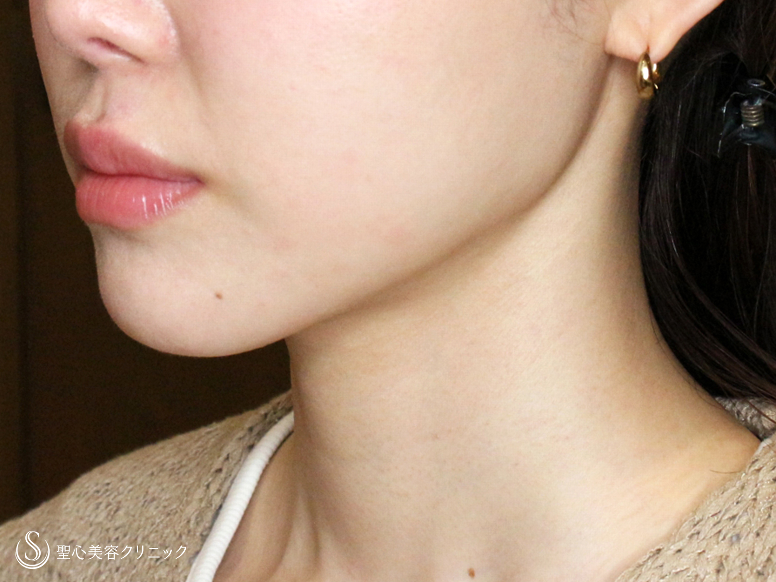 【30代女性・美しいフェイスラインで小顔に】脂肪吸引注射「あご下」（直後〜2ヶ月後） After 