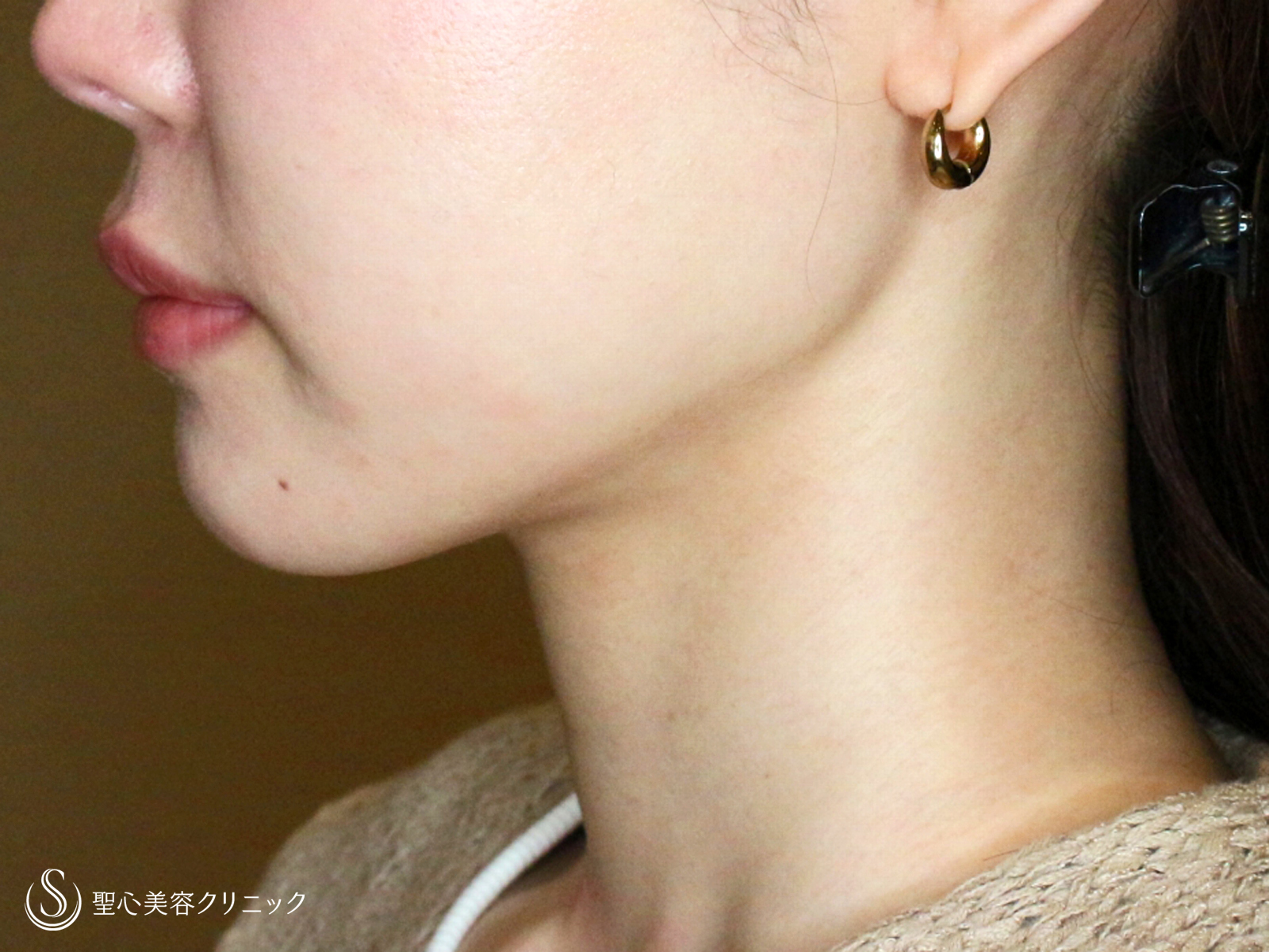 【30代女性・美しいフェイスラインで小顔に】脂肪吸引注射「あご下」（直後〜2ヶ月後） After 