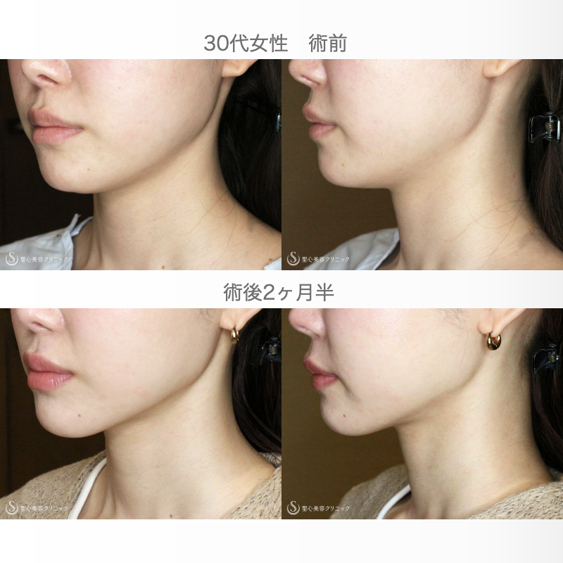 【30代女性・美しいフェイスラインで小顔に】脂肪吸引注射「あご下」（直後〜2ヶ月後） After 