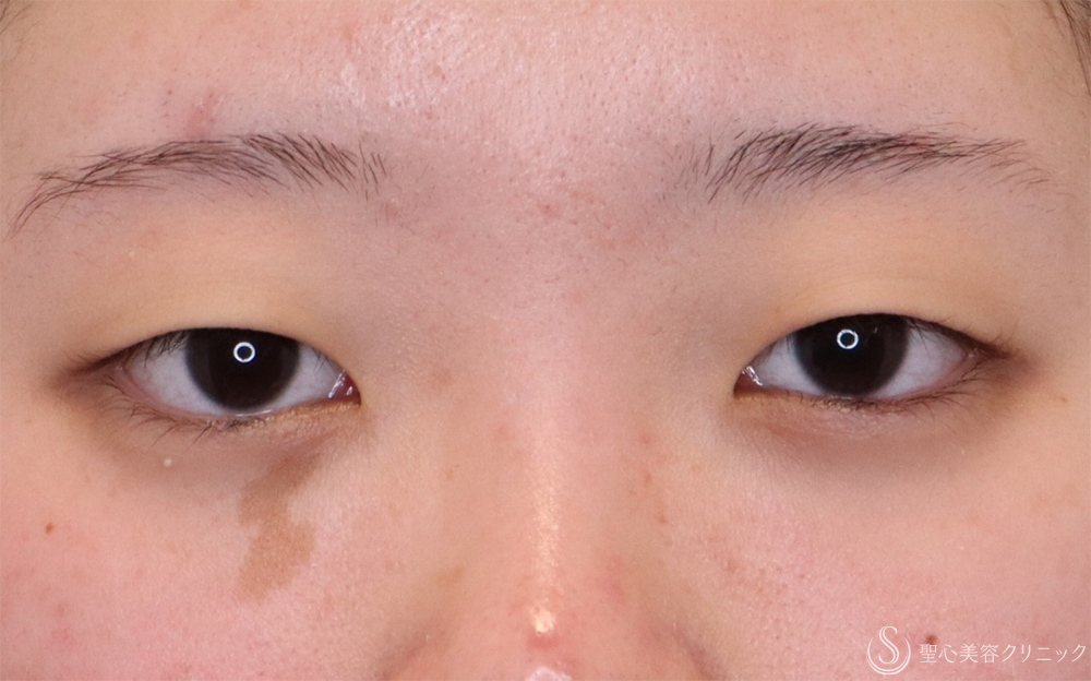 【10代女性・自然な目元に】二重埋没法：ダブルノット法（1ヶ月後） Before 