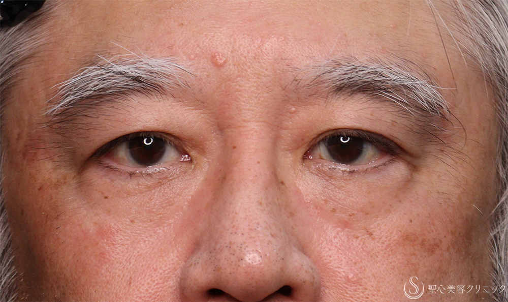 【60代男性・目の上のたるみ】右眉下切開（1ヶ月後） Before 