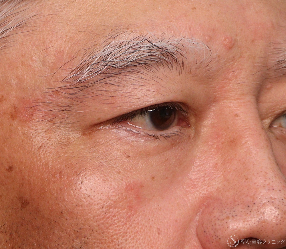 【60代男性・目の上のたるみ】右眉下切開（1ヶ月後） Before 