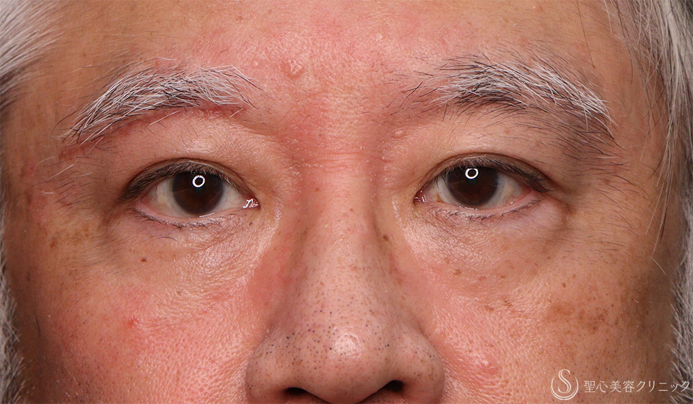 【60代男性・目の上のたるみ】右眉下切開（1ヶ月後） After 