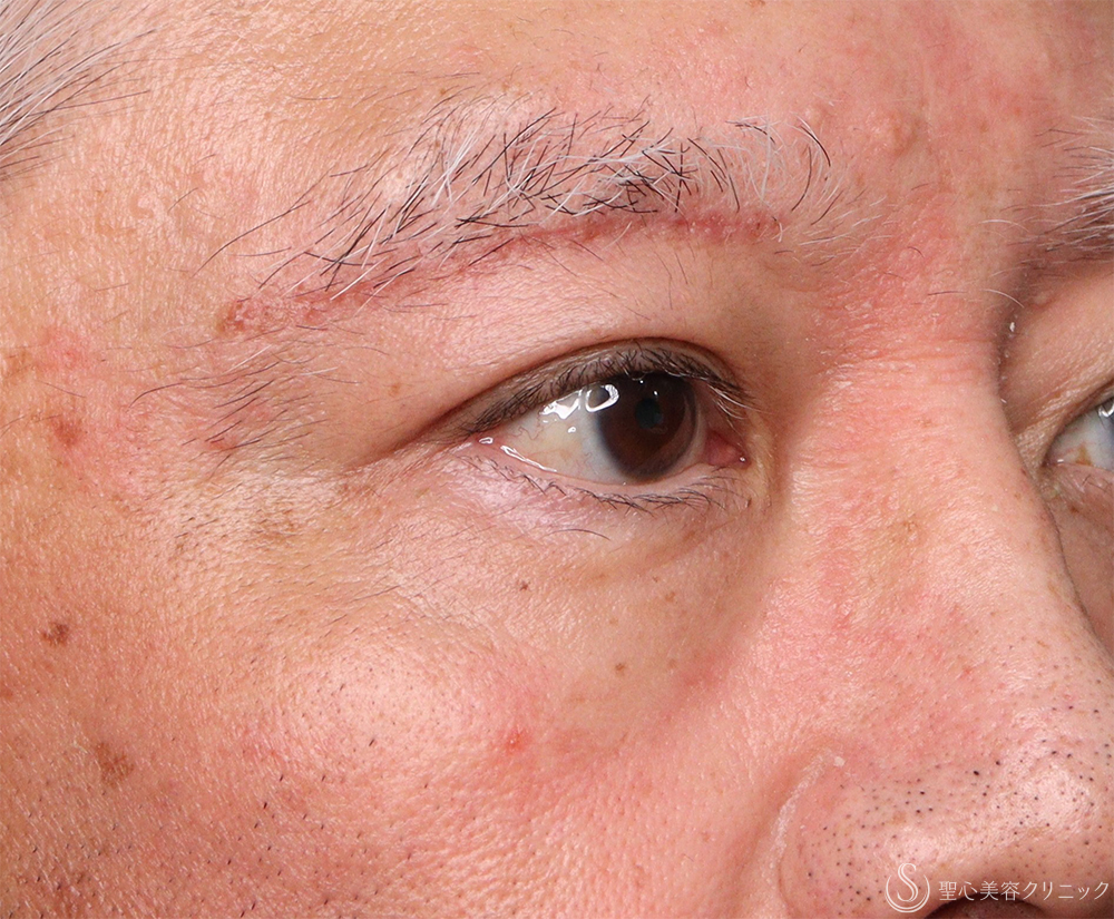 【60代男性・目の上のたるみ】右眉下切開（1ヶ月後） After 