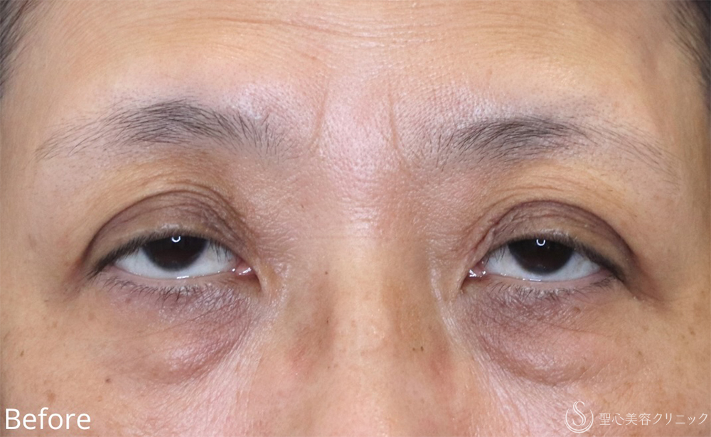 【60代女性・自然な仕上がり】眼瞼下垂（1ヶ月後） Before 