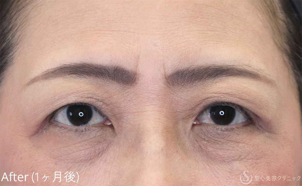 【60代女性・自然な仕上がり】眼瞼下垂（1ヶ月後） After 