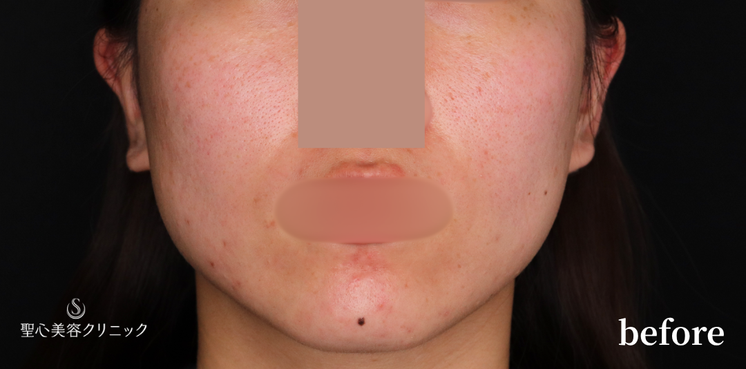 【30代女性・すっきりとしたフェイスラインに】ボツリヌトキシン注入（1ヶ月後） Before 