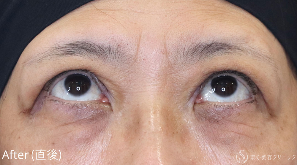 【60代女性・自然な仕上がり】眼瞼下垂（1ヶ月後） After 