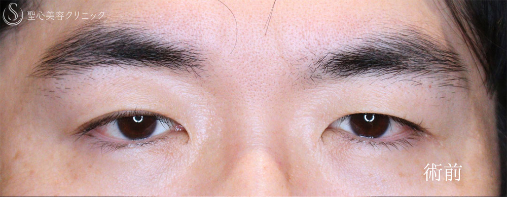 【40代男性・凛々しい目元に】眼瞼下垂＋眉下リフト（1年8ヶ月後） Before 