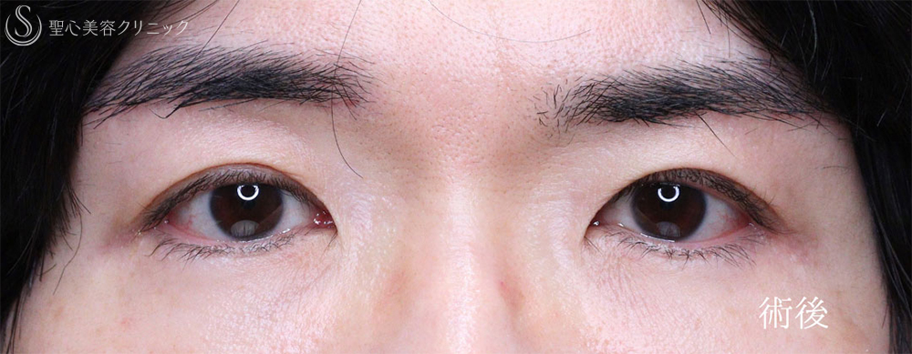 【40代男性・凛々しい目元に】眼瞼下垂＋眉下リフト（1年8ヶ月後） After 