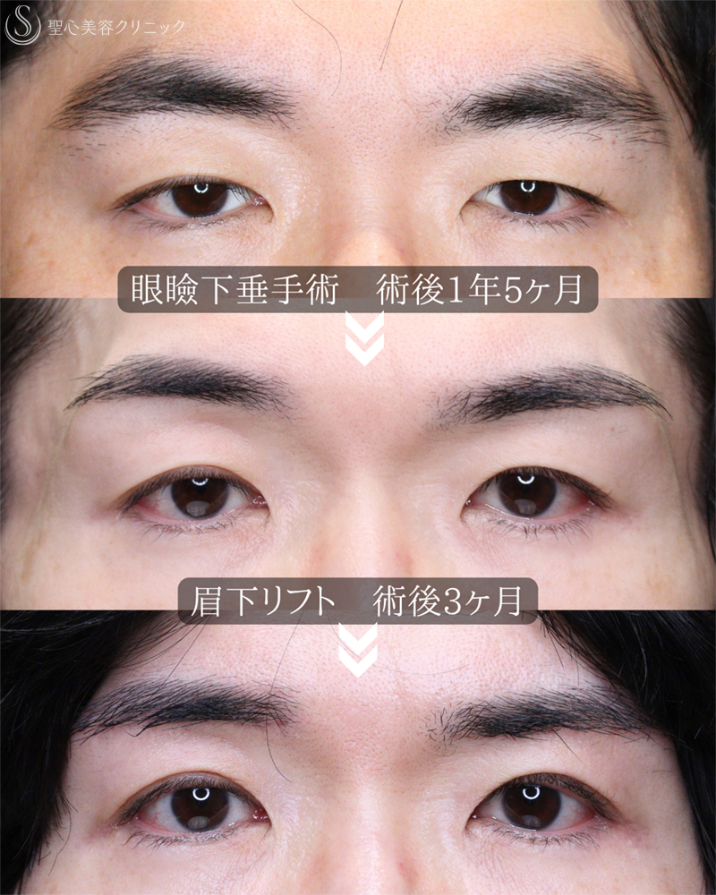 【40代男性・凛々しい目元に】眼瞼下垂＋眉下リフト（1年8ヶ月後） After 
