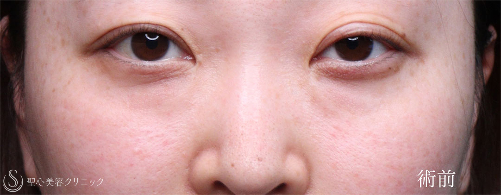 【30代女性・傷跡なしのクマ改善】裏ハムラ法（1ヶ月後） Before 
