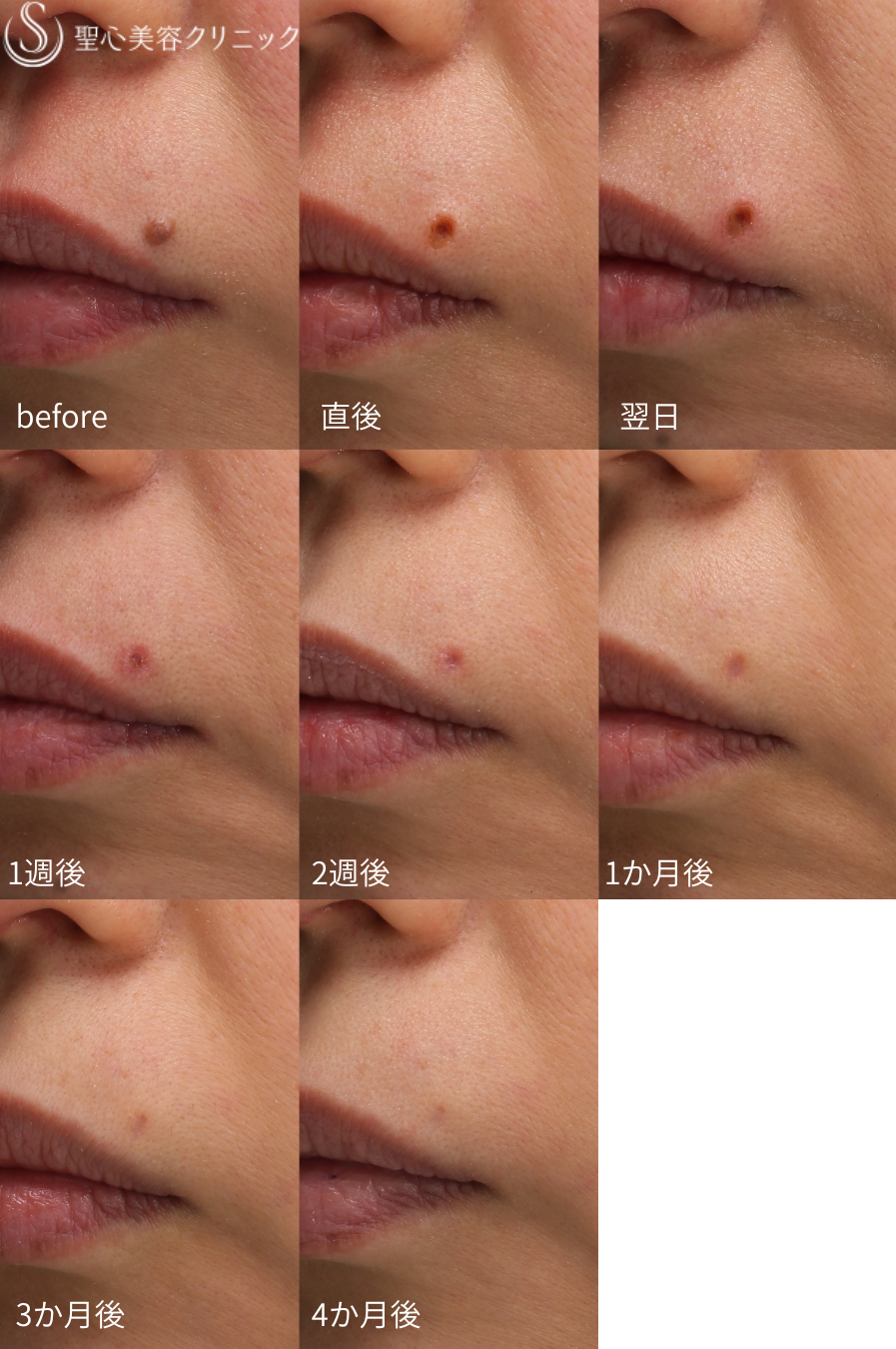 【40代女性・ホクロ】電気凝固法（4ヶ月後） After 
