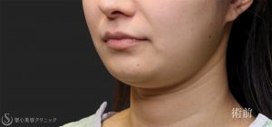 エラ張りの悩みを解決！専門家が教える原因と効果的な方法【エラ張り