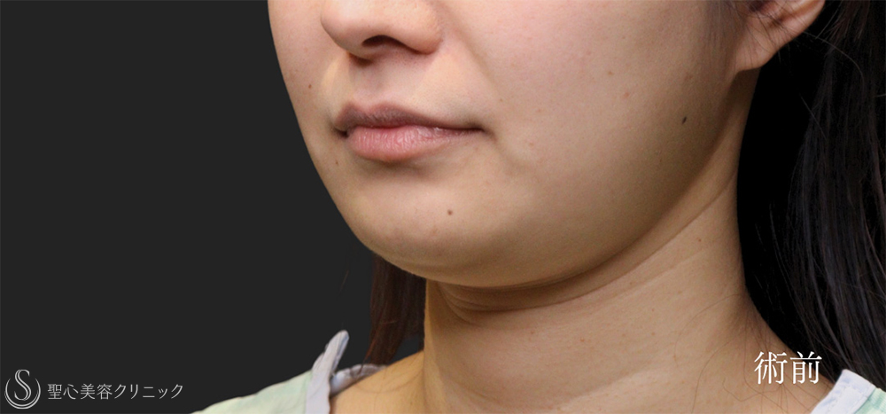【20代女性・頬・顎下の脂肪吸引で理想的なフェイスラインへ】脂肪吸引（脂肪除去）（6ヶ月後） Before 