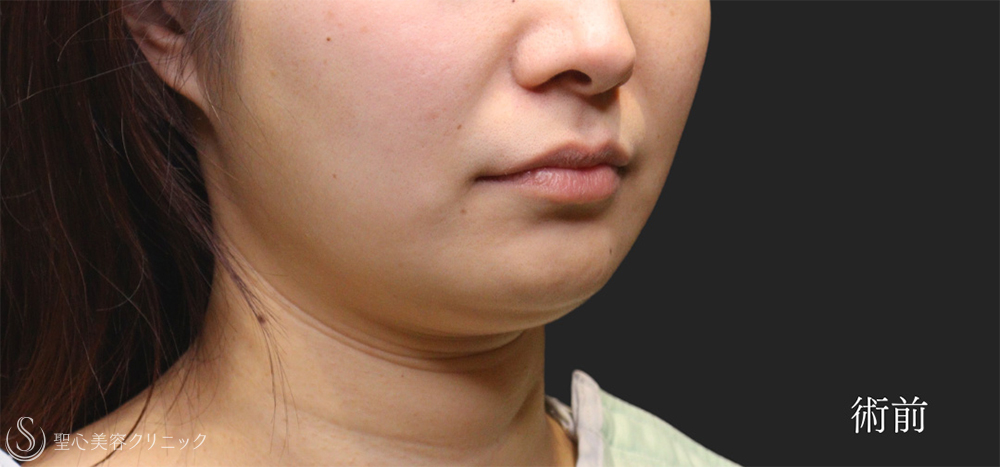 【20代女性・頬・顎下の脂肪吸引で理想的なフェイスラインへ】脂肪吸引（脂肪除去）（6ヶ月後） Before 