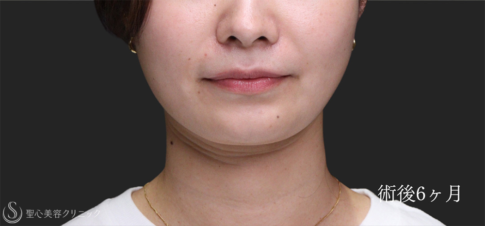 【20代女性・頬・顎下の脂肪吸引で理想的なフェイスラインへ】脂肪吸引（脂肪除去）（6ヶ月後） After 